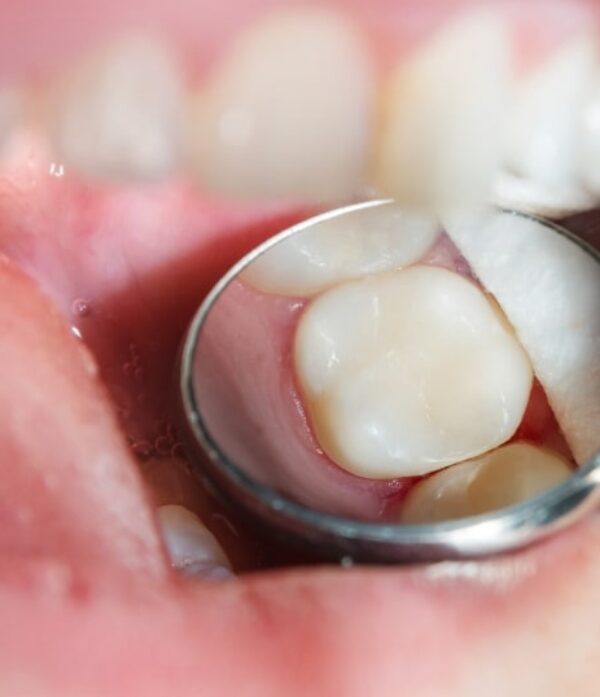 Treatment - Parkview Dental